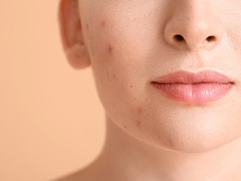 acne-and-acne-scar-laser-treatment