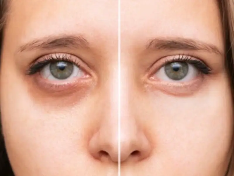 balikesir-under-eye-dark-circle-treatment