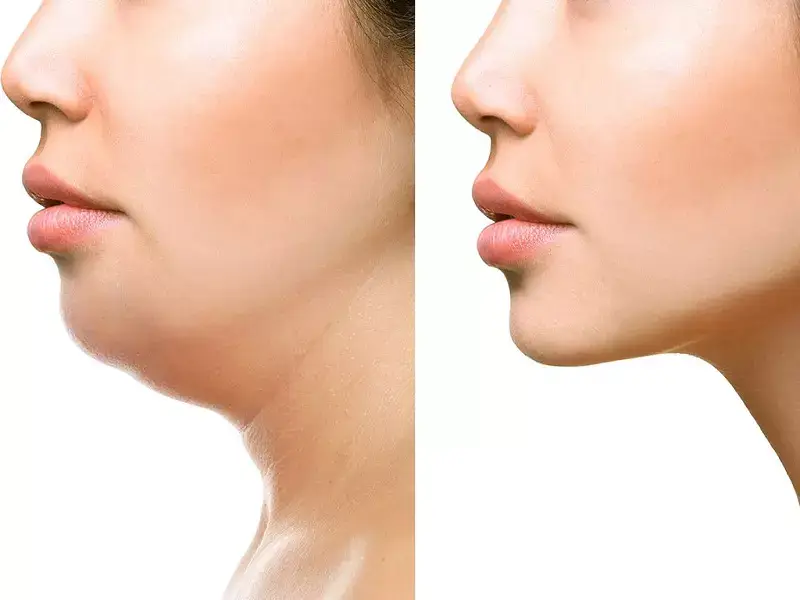 bilecik-chin-fat-reduction