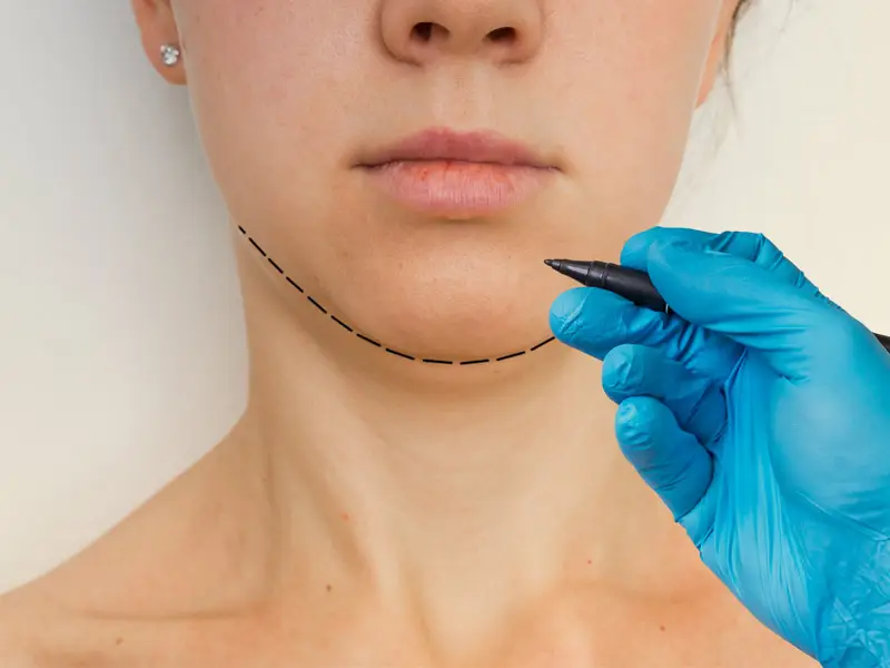 bursa-under-chin-tightening