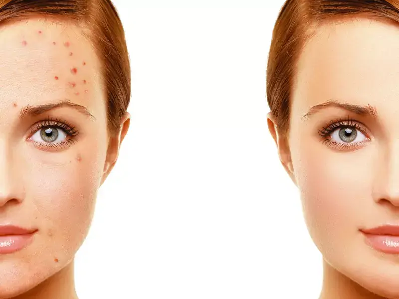 how-long-does-acne-treatment-take