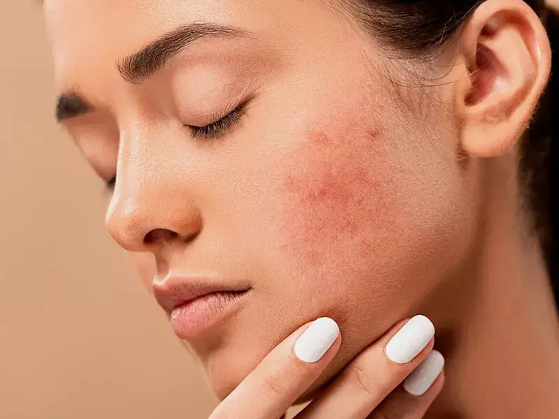 laser-treatment-for-skin-spots