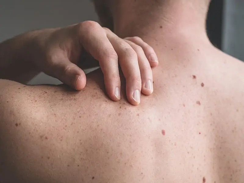 mole-treatment