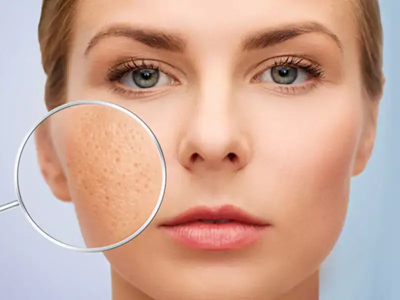 Pore ​​Tightening
