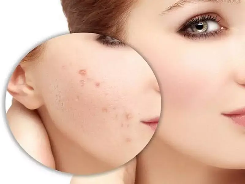 post-acne-scar-laser
