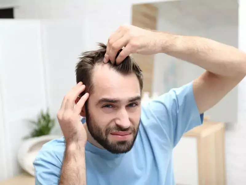 what-is-male-pattern-hair-loss