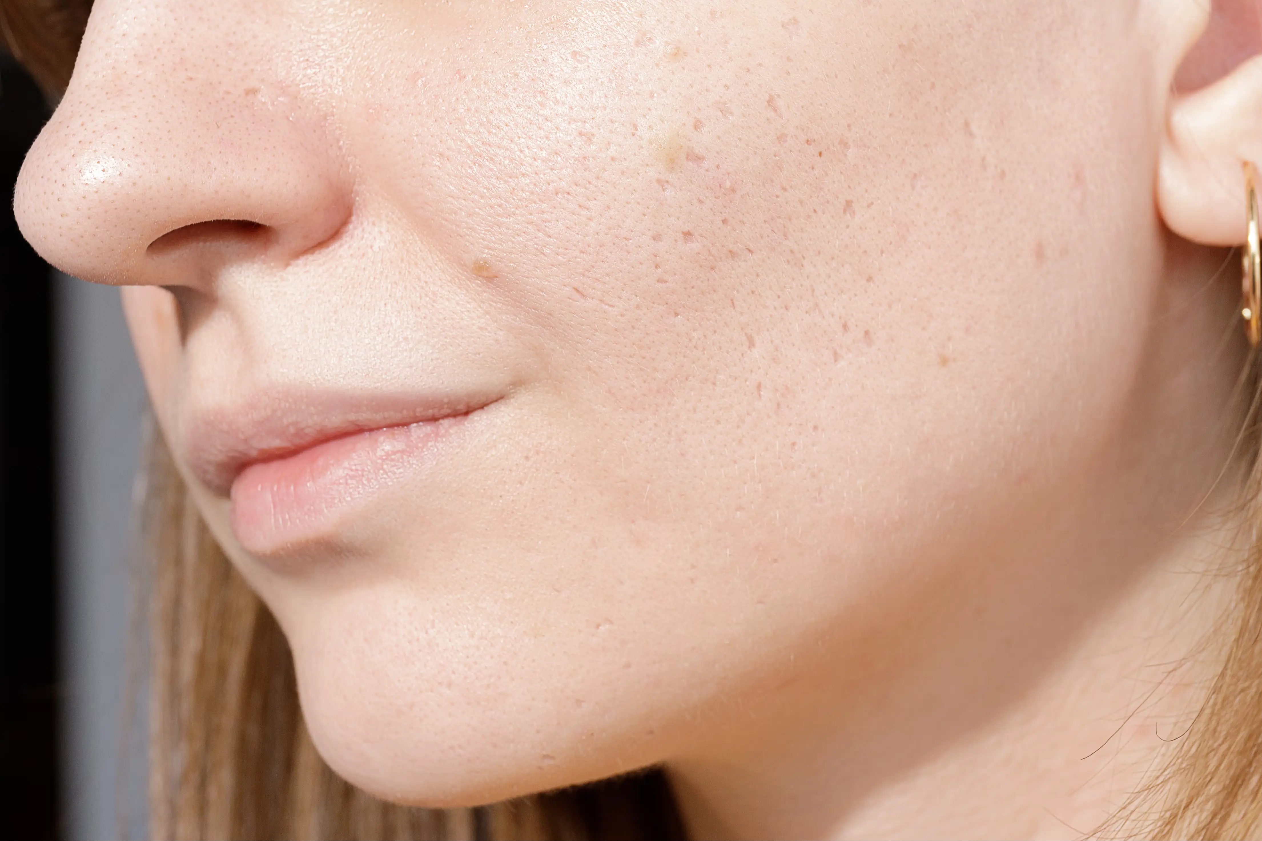 yuzun-delik-delik-olmasi